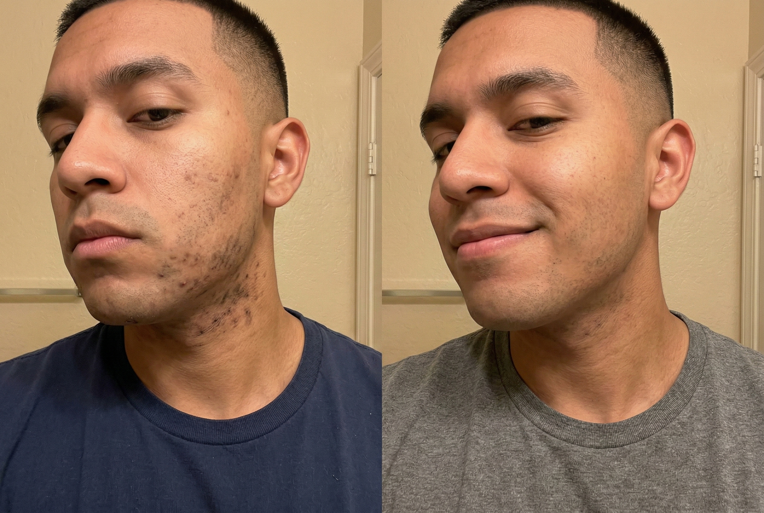 Daniel, 23 before and after using DARK